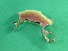 札幌南区の歯医者さんは多くありますが、こだわりの入れ歯治療のクリニックは少ないかと思われます。当院の痛くなく良く噛める入れ歯のページです。写真。上顎前歯部、5歯欠損症例。