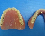 札幌南区の北の沢きたのさわ夜間歯科・矯正歯科。痛くない入れ歯・若さ戻る審美義歯は院長が担当しています。上下フルデンチャーの写真。特殊人工歯使用例。