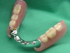 札幌南区の北の沢きたのさわ夜間歯科・矯正歯科の入れ歯（自費）のご提案例。両側有離端のノンクラスプ。メタルアップ症例。
