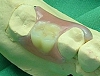 札幌南区の北の沢きたのさわ夜間歯科・矯正歯科の審美入れ歯（自費）のご提案例。。ノンクラスプタイプ。上顎の１歯欠損例。左上６番欠損。ポリアミド樹脂使用。