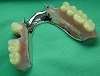 札幌南区の北の沢きたのさわ夜間歯科・矯正歯科の審美入れ歯（自費）のご提案例。上顎の両側遊離端欠損タイプ。口蓋のレジン床レスタイプ。軽くて、味覚も失われません。