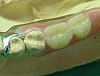 札幌南区で快適な入れ歯治療を受けられます。それは、夜間診療のスタイルでお忙しい方でも快適通院だからです。北の沢きたのさわ夜間歯科・矯正歯科の審美入れ歯（自費）のご提案例。ノンクラスプタイプ２歯欠損。咬合面近心レストあり。