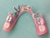 札幌南区の北の沢きたのさわ夜間歯科・矯正歯科の審美入れ歯例（自費）。下顎両側ノンクラスプ例。遊離端欠損症例。