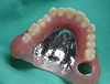札幌南区の北の沢きたのさわ夜間歯科・矯正歯科の審美入れ歯例。ノンクラスプタイプ右側遊離端。エステショット樹脂使用。