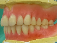 札幌の南区の入れ歯治療を専門的に夜間時間に行っている歯医者さんの北の沢夜間歯科・矯正歯科の入れ歯の治療ポイントは、痛くなく噛めるだけではなく、審美性も大事にしております。人工歯排列のモデル写真。