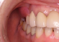痛くないノンクラスプ審美入れ歯を説明するための写真。ノンクラスプデンチャー(正面像)の写真です。エステショット使用。