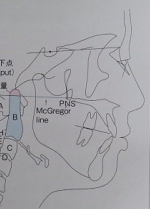 札幌南区の北の沢きたのさわ夜間歯科・矯正歯科。痛くないヘルスケア審美入れ歯の治療では、セファロレントゲンも活用しています。側面頭部の骨格の基準線のイラスト。軸堆は青色です。