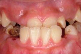 レーザー治療症例。歯肉炎の症例