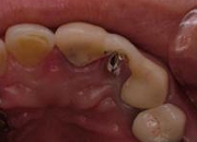 レーザー治療症例写真。術後経過中で歯の牽引矯正を併用している写真。