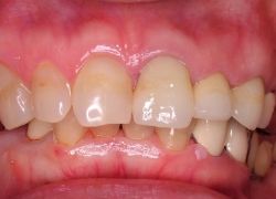 レーザー治療症例3。術後、セラミック治療を併用。