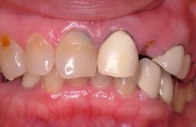 レーザー治療症例２。術前の写真。全顎的に中等度の歯周炎。
