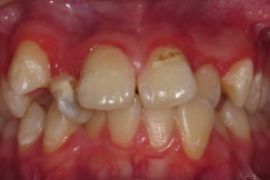 レーザー治療症例2。歯周炎の症例