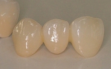 審美歯科例。オールセラミックス冠の写真、前歯３歯の連結冠。
