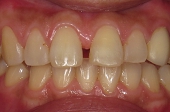 セラミック審美歯科の症例。術前、diastema、上顎中切歯の正中離開の症例。