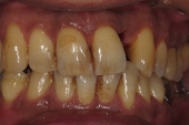 セラミック審美歯科の症例。術前の写真、左上２番を保存不可のため抜歯した。その後、左上１、２、３番にセラミックブリッジを装着した。生活形成。A2の接着性セメントにてセット。シランカップリング処理あり。