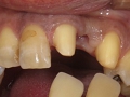 セラミック審美歯科の症例。歯髄を温存し、生活歯のままで支台歯形成を行った。最終印象時の写真。