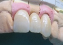 セラミック審美歯科の症例。製作されたセラミック冠の写真。左上１、２，３番のブリッジ（二番が欠損）。
