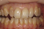 セラミック審美歯科の症例。術前の写真、右上2番の歯髄壊死による歯質の変色が主訴。歯髄の処置を行い、セラミック冠にて審美的改善を行うこととした。