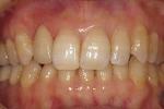 セラミック審美歯科の症例。セラミック治療後の写真。
