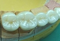 セラミック審美歯科の症例。右下４－７番用に製作されたフルジルコニア（ステイン法）ガム模型の写真。