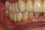 セラミック審美歯科の症例。フルジルコニア治療後の写真。右下４番から７番までのブリッジ症例。