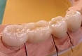 セラミック審美歯科の症例。製作されたフルジルコニアクラウンの写真。