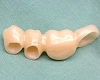 セラミック審美歯科の症例。製作されたフルジルコニアの写真。内面の様子、メタルレスのため全方位から審美性が極めて高く、かつ強度が大きい材質。