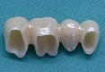 セラミック審美歯科の症例。製作されたフルジルコニア（ステイン法）の内面の写真。