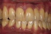 セラミック審美歯科の症例。セラミック治療後の写真。３歯ブリッジオールセラミック冠を装着後。