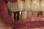 セラミック審美歯科の症例。術前の写真、右下４－７番のメタルクラウンの不適合あり。カリエスを認める。