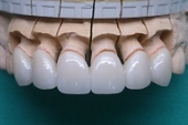 zirconia. one piece anterior crown(stain version). ジルコニア前歯部の６歯連結冠の製作例（模型上）。