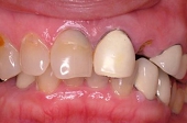 セラミック審美歯科の症例。術前、左上１番の前装冠の審美不良と左上2番の歯冠上部の破折が主訴。