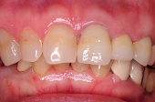セラミック審美歯科の症例。術後、左上２番を提出矯正した後に、左上１から３番をジルコニア－セラミック冠にて修復治療。