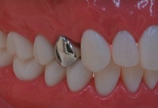 臼歯部の銀歯、メタルクラウンの審美不良さを示すサンプル写真。右上４番の健康保険適用のフルクラウンFMC。拡大。