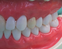 臼歯部の銀歯、メタルクラウンの審美不良さを改善するセラミック治療のサンプル模型の写真。左上４番の健康保険適用外のオールセラミックスのフルクラウン、ｅ-max使用。