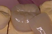 オールセラミックの製作例を示した写真。審美歯科コーナー３