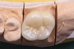 審美オールセラミックス例。大臼歯、右上６番。歯質破折によりクラウンにて修復治療を行いました。、生活歯の形成。