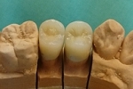 審美歯科症例。ハイブリッドセラミックオールセラミックメタルバッキング臼歯例、右上４&５番。メタルバッキングにてパラファンクションによる修復歯の破折を予防した。主症状は4番は既存の保険レジン歯の審美障害。５番は保険レジンクラウンの破折。グラスアイオノマーセメントにより合着予定。