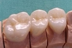 審美冠の症例。フルジルコニア臼歯例、右上４，５，６番。ステイン法。