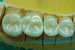 審美歯科症例。フルジルコニア臼歯例、左上４，５，６，７番。ステイン法。