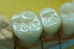 審美歯科症例。フルジルコニア臼歯例、左上５，６番。スタンダード法。4番は健康保険適用のジャケットクラウン。