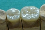 フルジルコニア臼歯、右下５、６番。スタンダードカラー。単冠×２本。