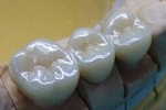 フルジルコニア臼歯、右上４，５，６番。ステインカラー。右上5番を歯根破折のため抜歯、その後ブリッジにて機能回復を行った症例。