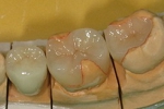 審美歯科のページ/審美オールセラミックス＆ハイブリッドセラミックス例、左下５・６・７番。