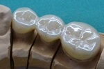 審美歯科症例。フルジルコニア臼歯ブリッジ、右下４，５，６番。スタンダードカラー。