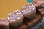 審美歯科症例。フルジルコニア大臼歯、左下６，７番。ステインカラー。単冠×２。