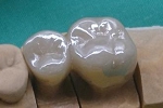 審美歯科症例。フルジルコニア臼歯、左上５、６番。ステインカラー。単冠×２を連結して動揺防止をはかった。