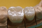 奥歯の審美フルジルコニア例、右下５，６番症例。単冠×２。6番はカリエス感染症による誘発痛のため既存ハイブリッドセラミック冠を除去。