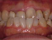 札幌南区北の沢夜間・矯正歯科。審美歯科症例。初診時の口腔内写真。前歯が逆被蓋で、前装冠とクラウンの不適合やカリエス虫歯による内部着色・変色もみられる。