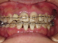 札幌南区北の沢夜間。審美歯科症例５。矯正中、下顎は２本抜歯にてアーチの縮小、上顎は前方拡大にて反対咬合の改善をはかる。